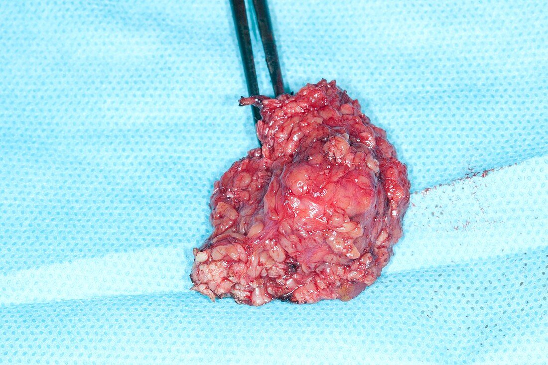 Excised parotid tumour
