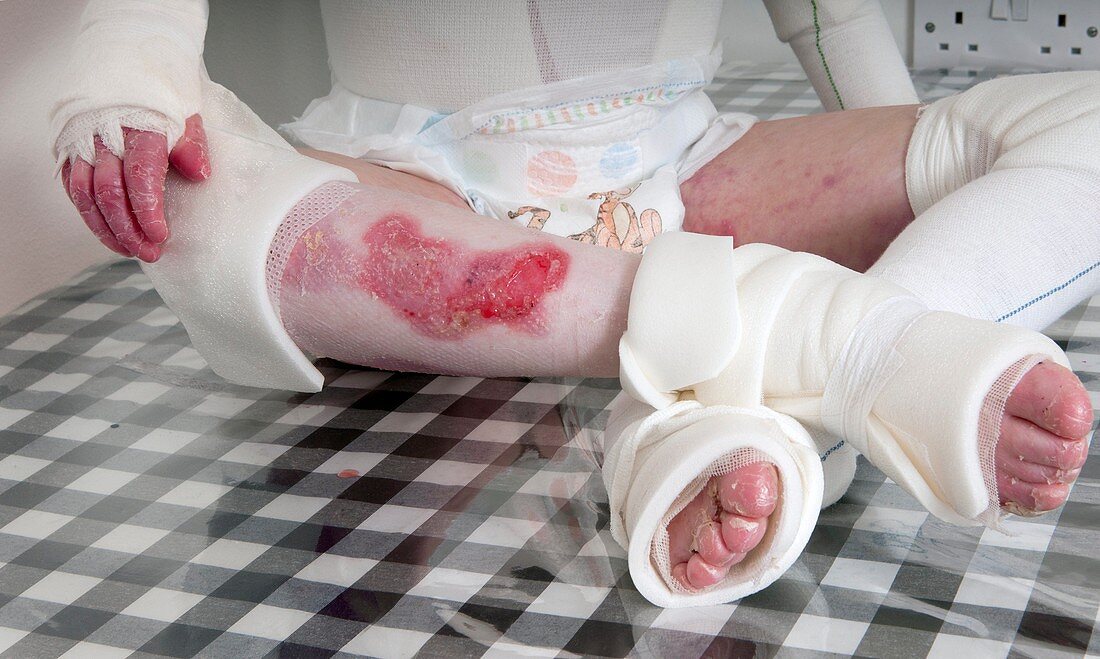 Leg of girl with epidermylosis bullosa