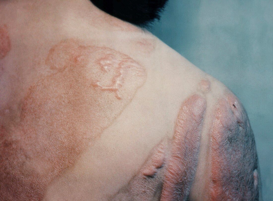 Radiation burn scars,Hiroshima,1945