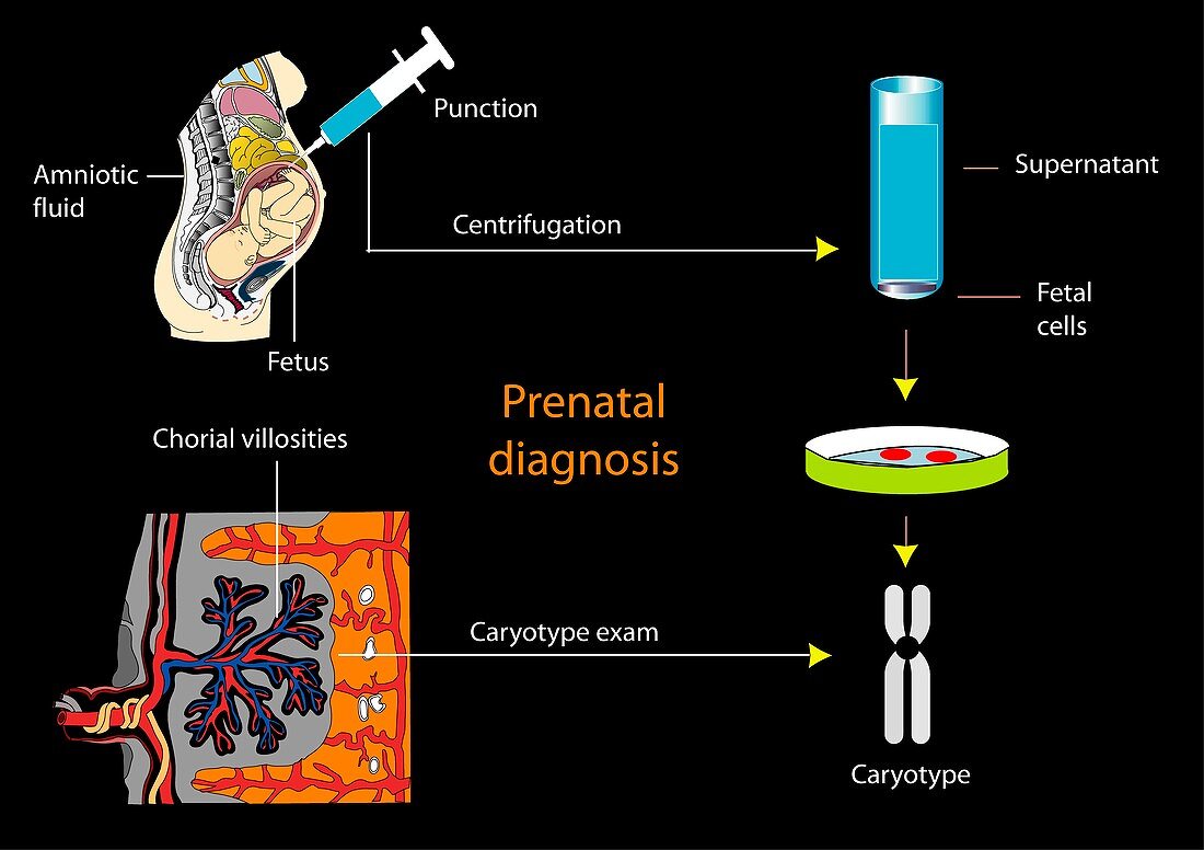 Prenatal screening,artwork