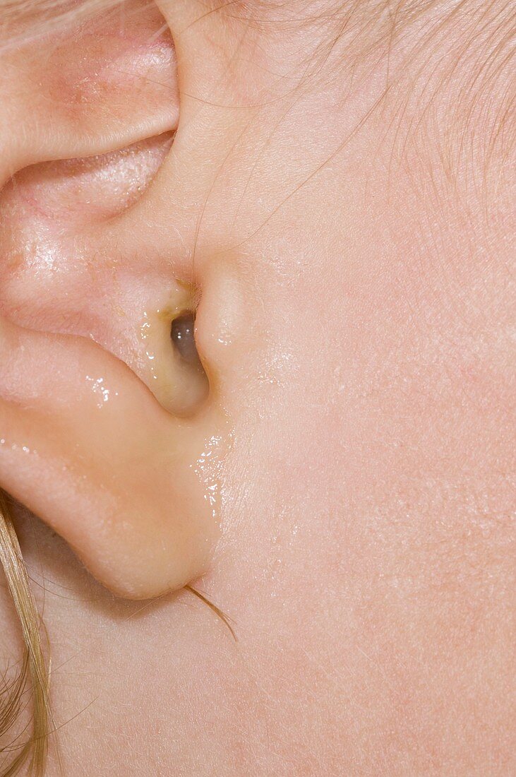 Middle ear infection
