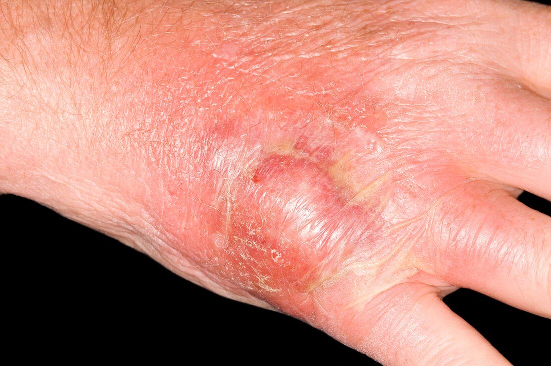 Abscess on hand after insect bite