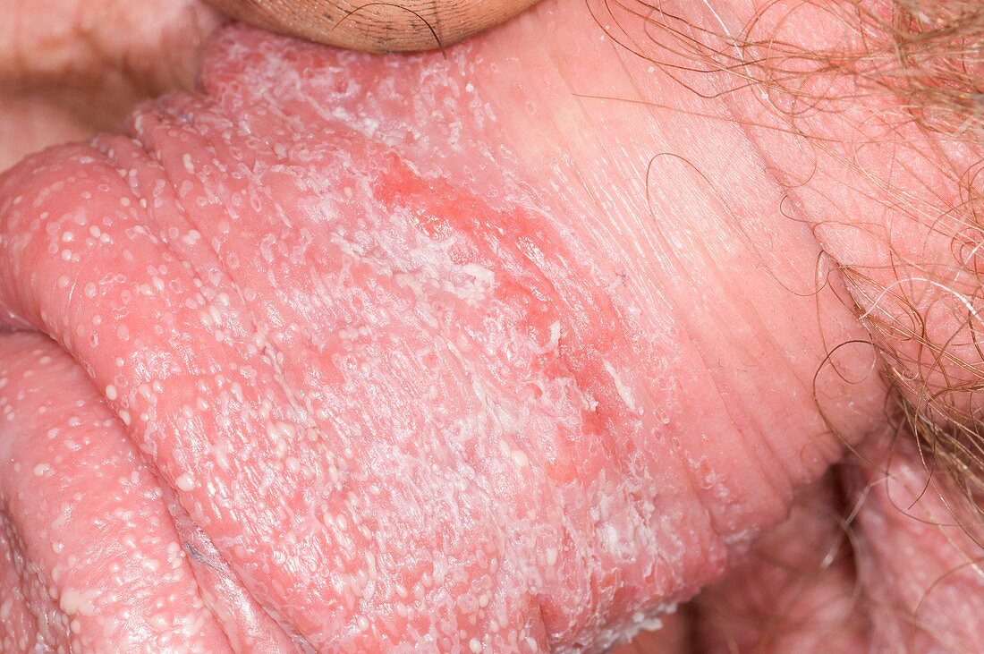 Thrush infection of the penis