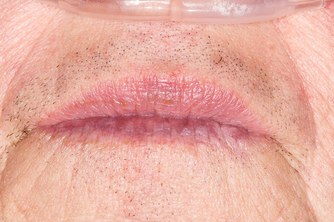 Purple lips due to cyanosis