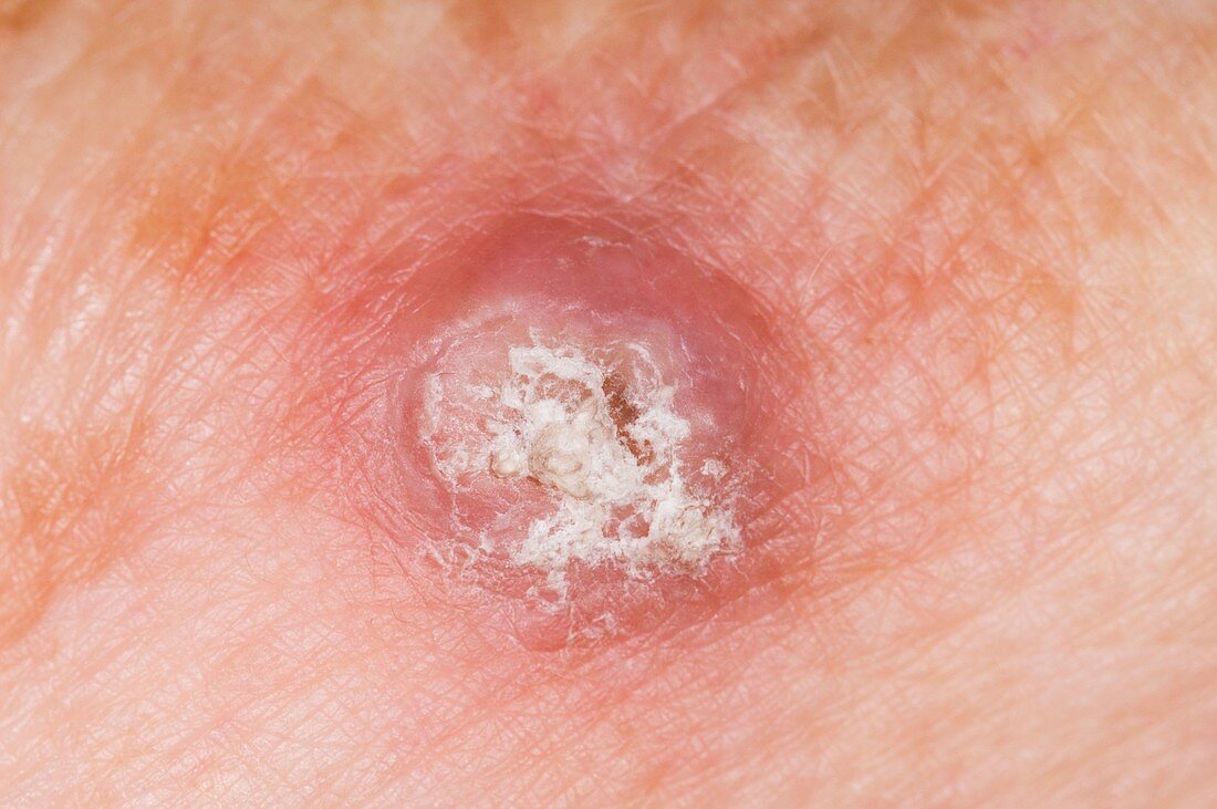 Keratoacanthoma on the skin