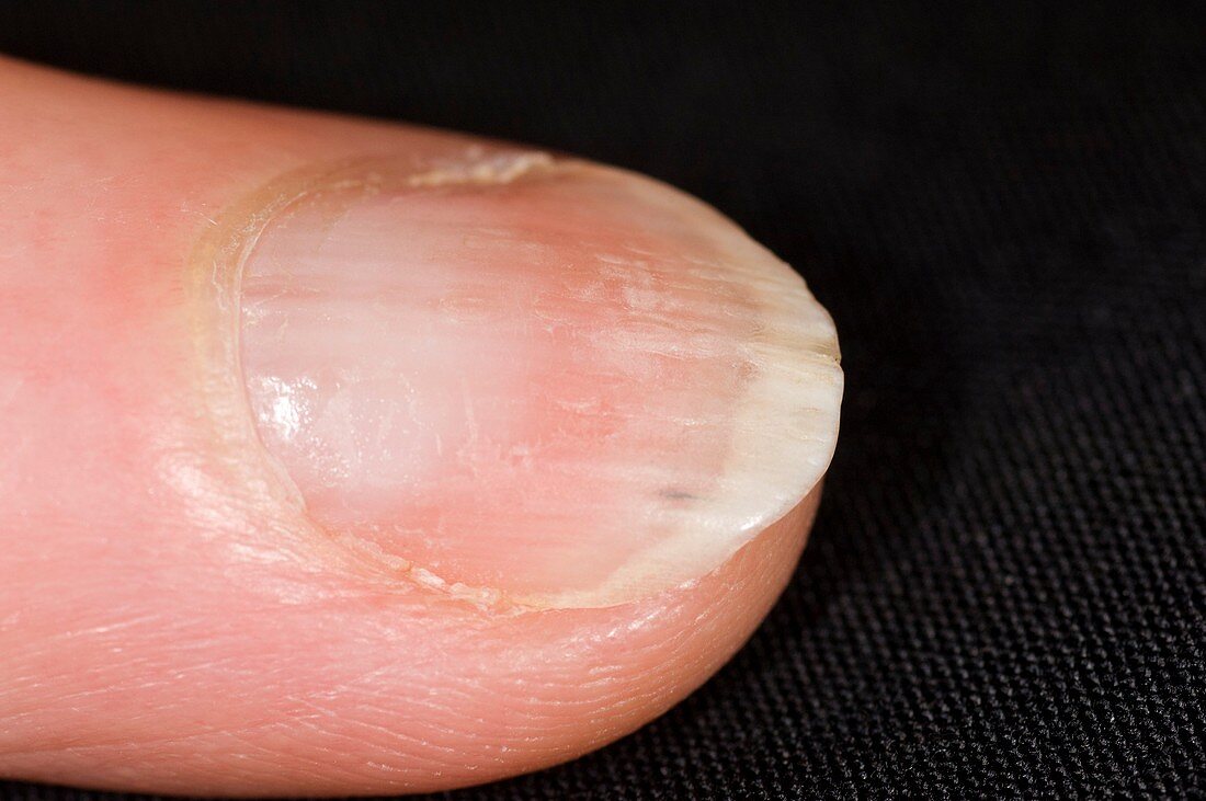 Longitudinal ridges along the fingernail