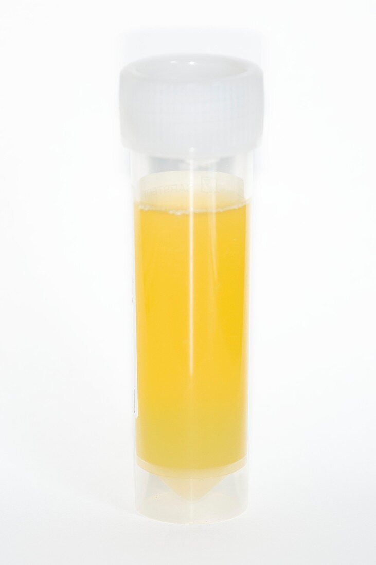 Fluid sample from knee with gout