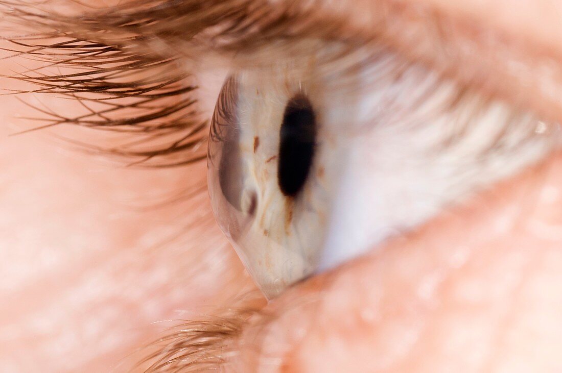 Keratoconus of the eye