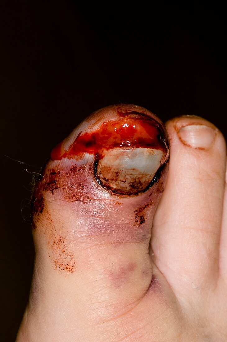 Broken toe from crush injury