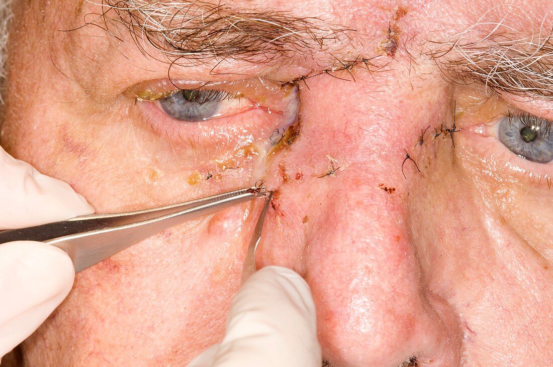 Face wound after removing skin cancer