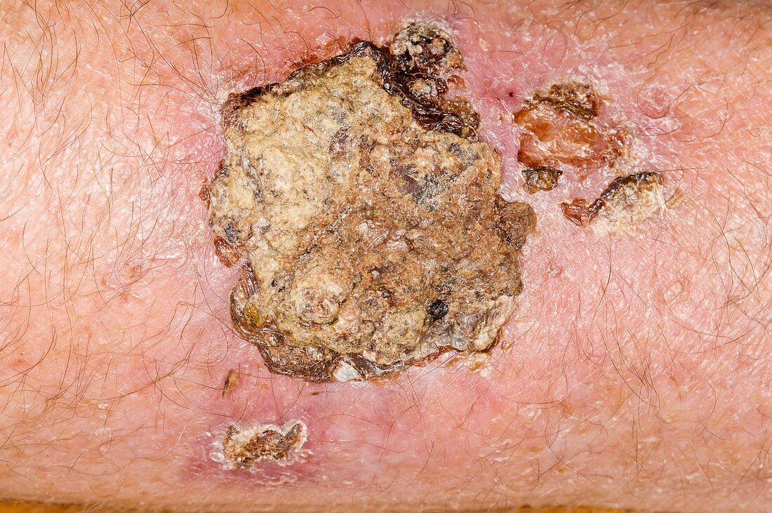 Healing scab on the arm
