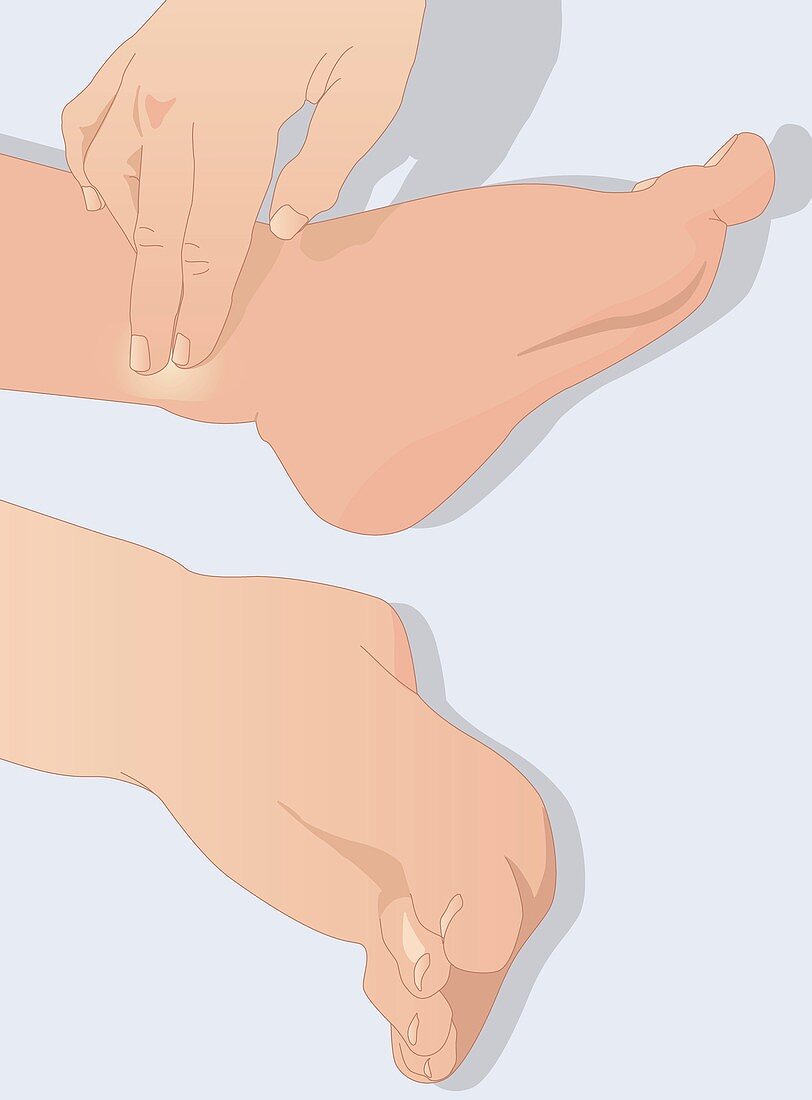 Swollen legs and feet,artwork