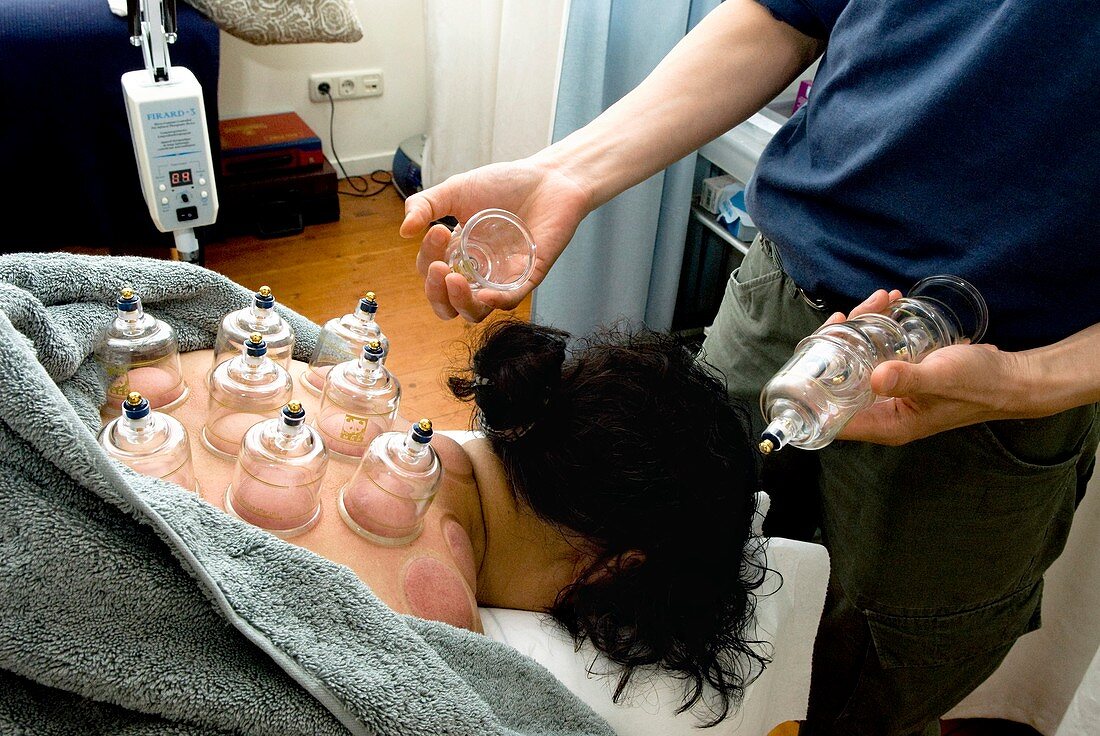 Cupping acupuncture