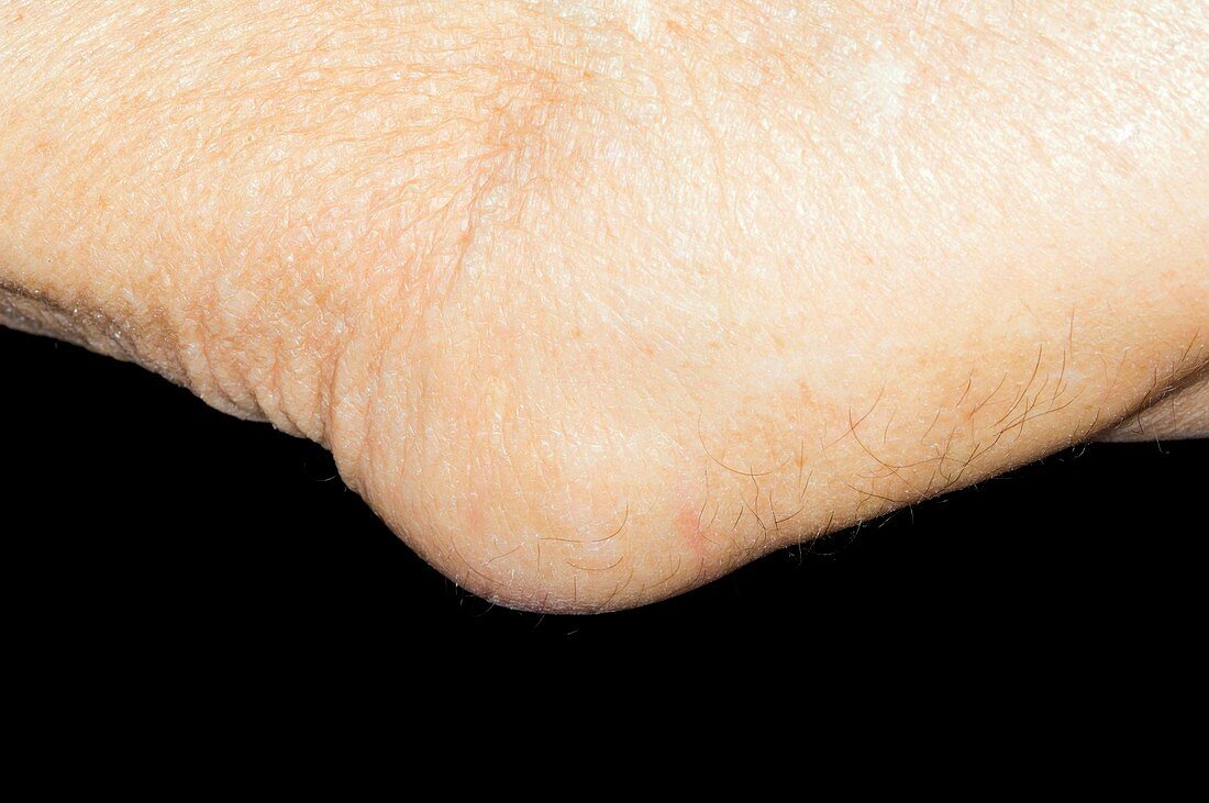 Bursitis in the elbow joint