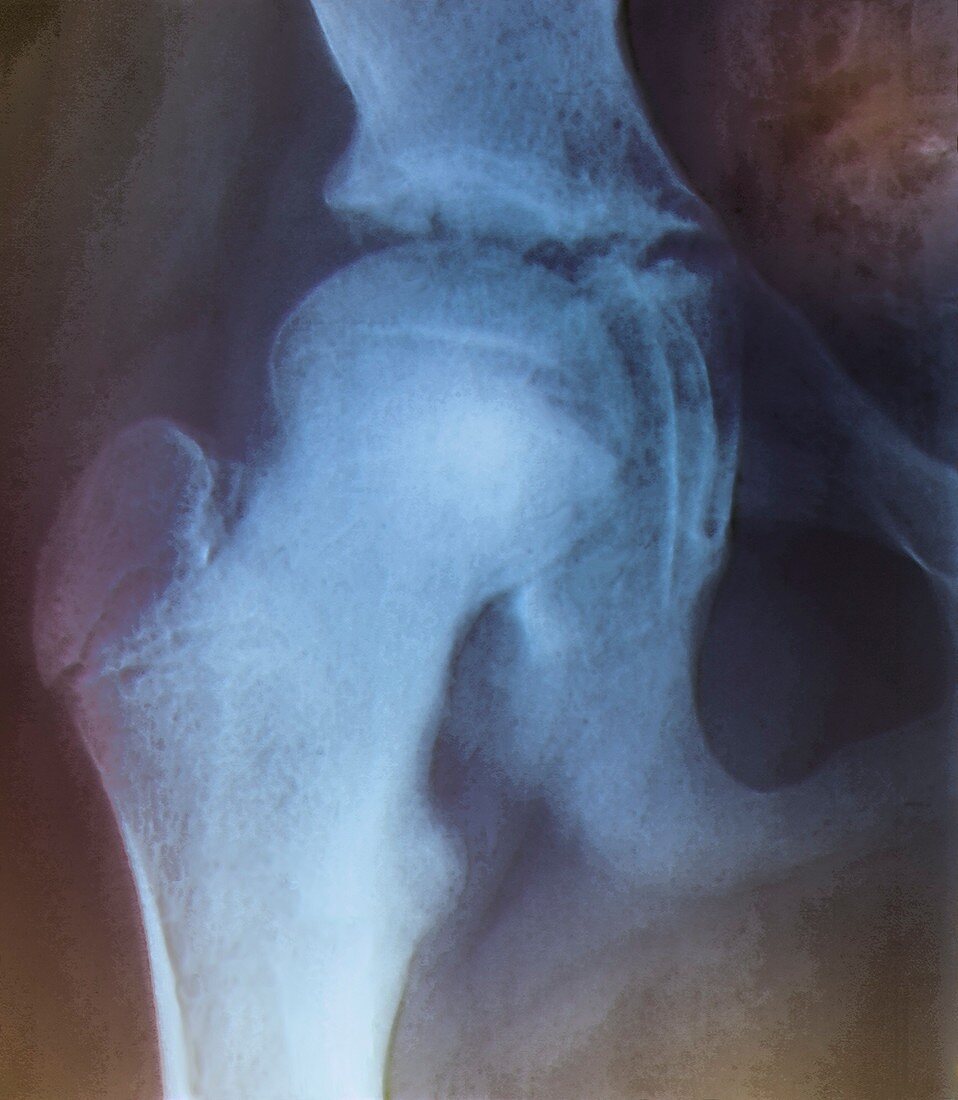 Slipped end of thigh bone,X-ray
