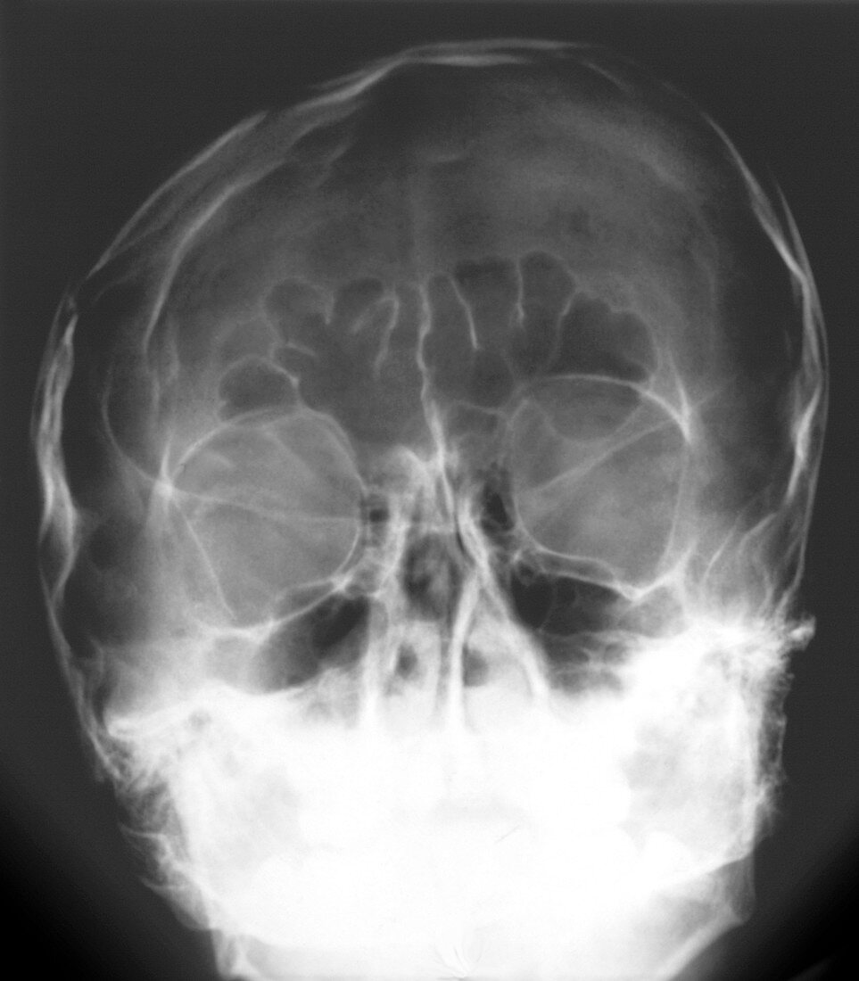 Facial injury to the skull,X-ray