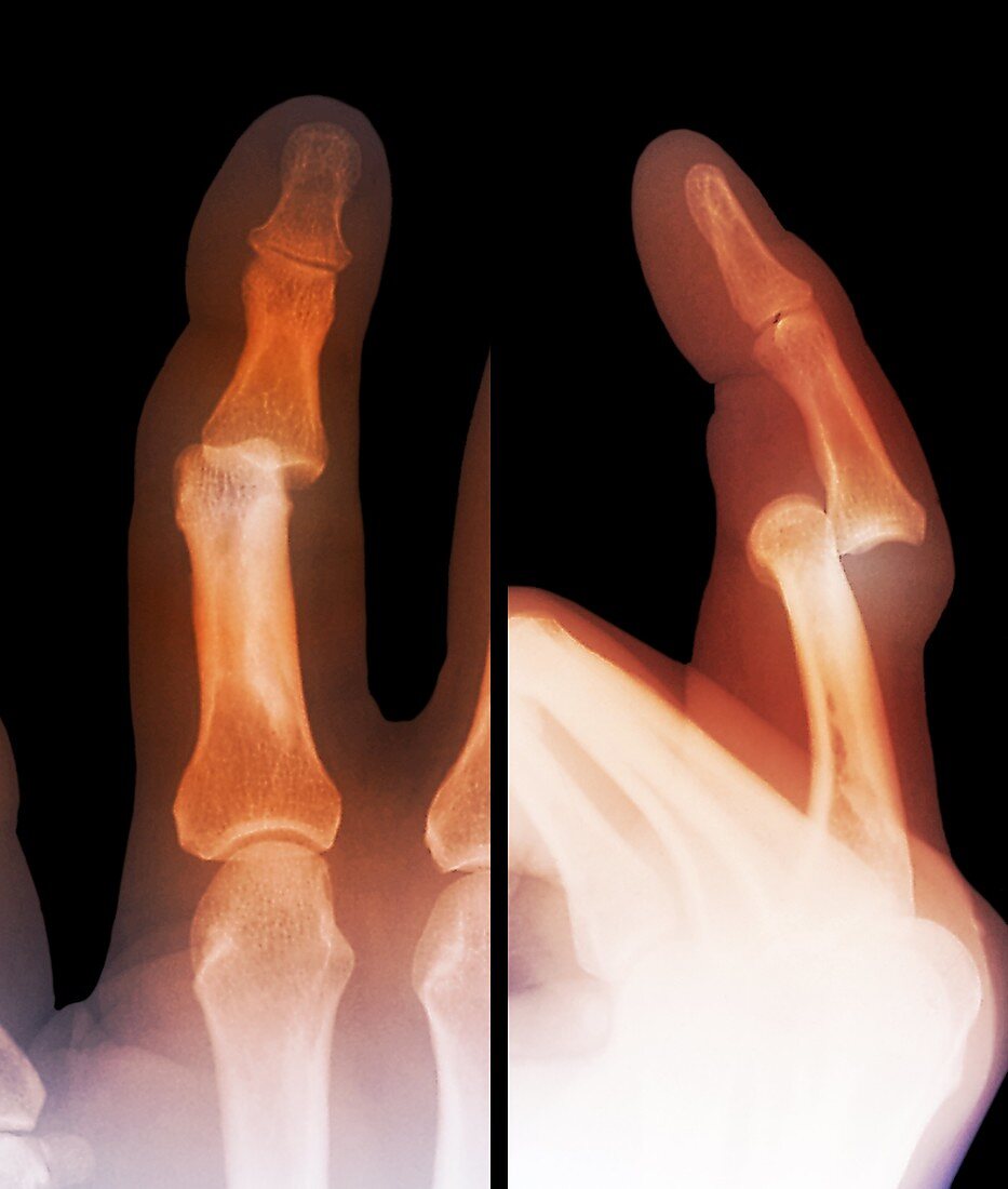 Dislocated finger joint,X-ray