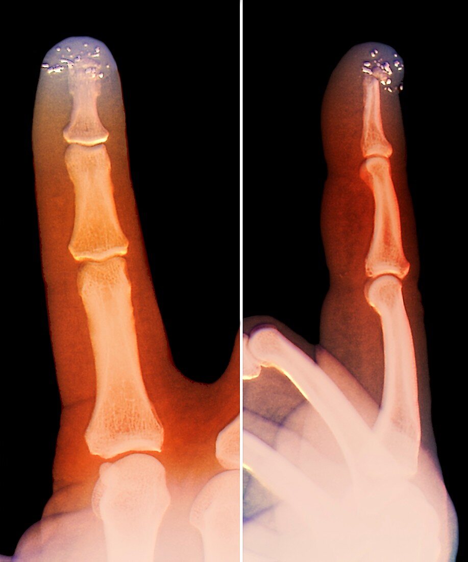 Metal filings in the finger,X-ray