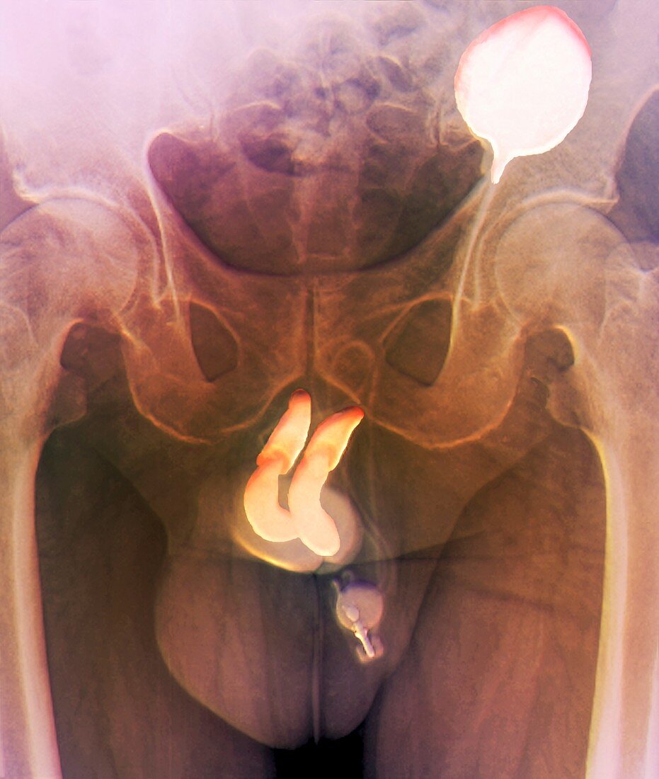 Penis prosthesis with pump,X-ray