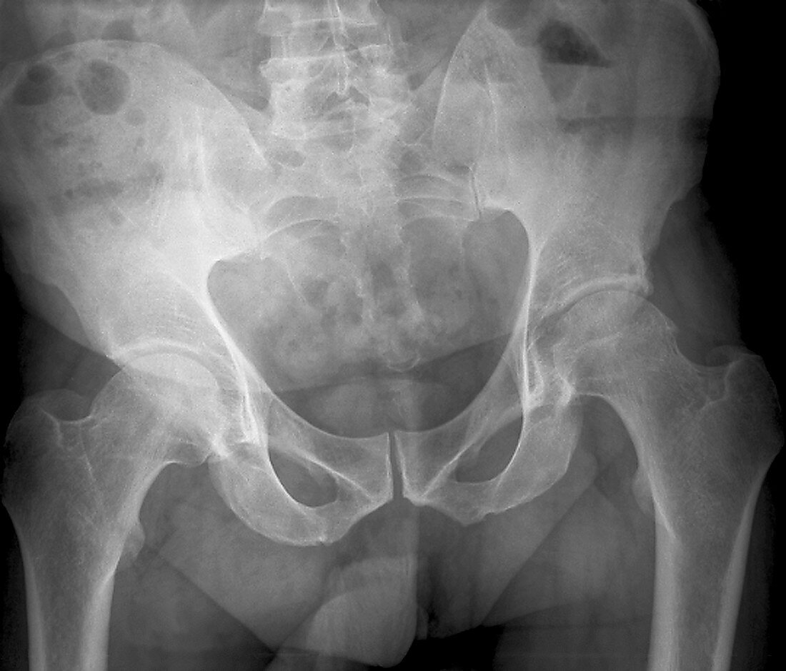 Pelvis with a leaning posture,X-ray