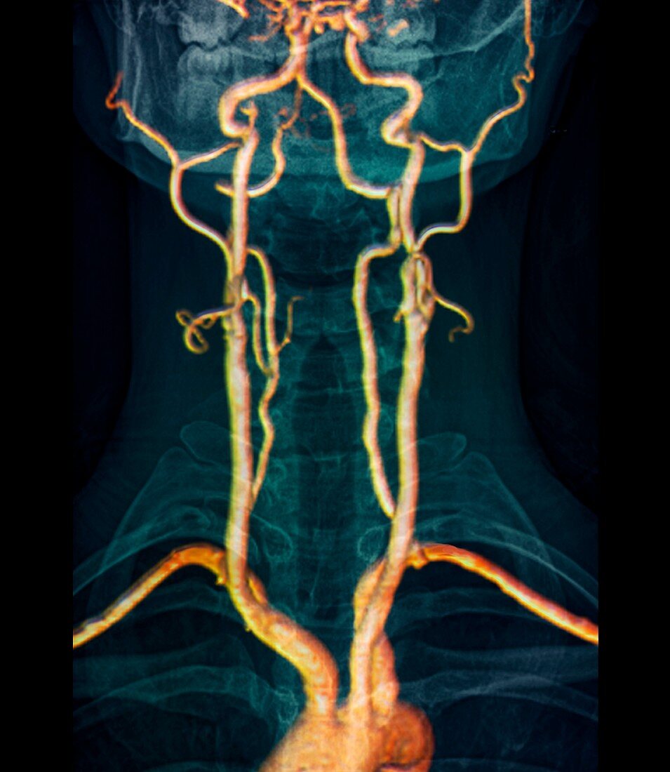 Neck arteries to the brain,3D MRI scan