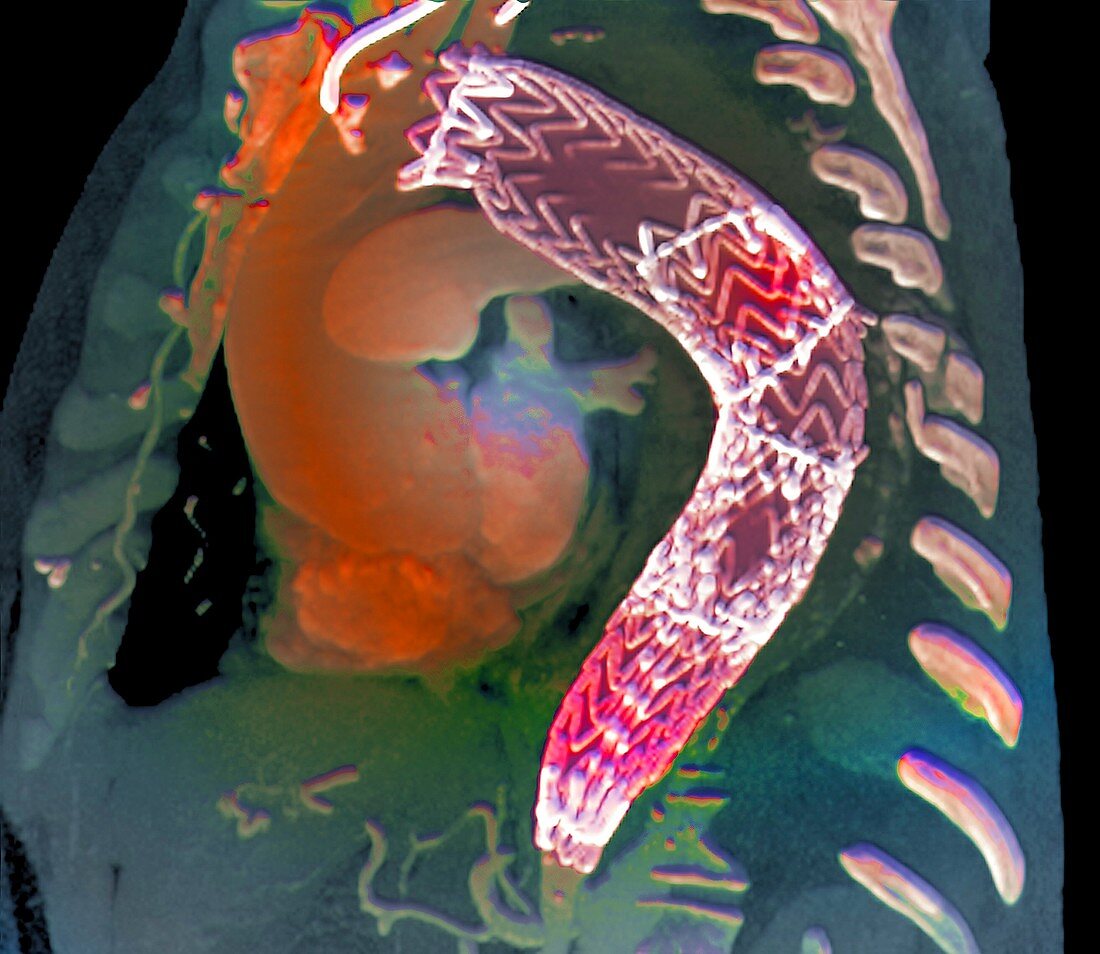 Stent to treat aortic aneurysm,CT scan