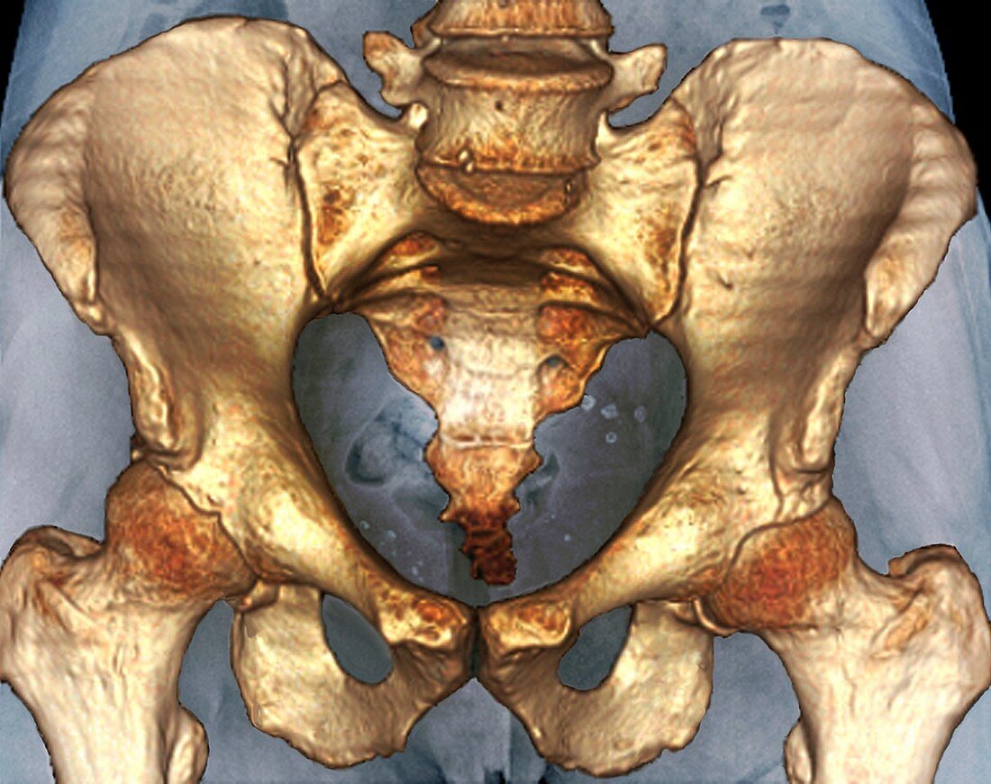 Healthy pelvis,3D CT scan