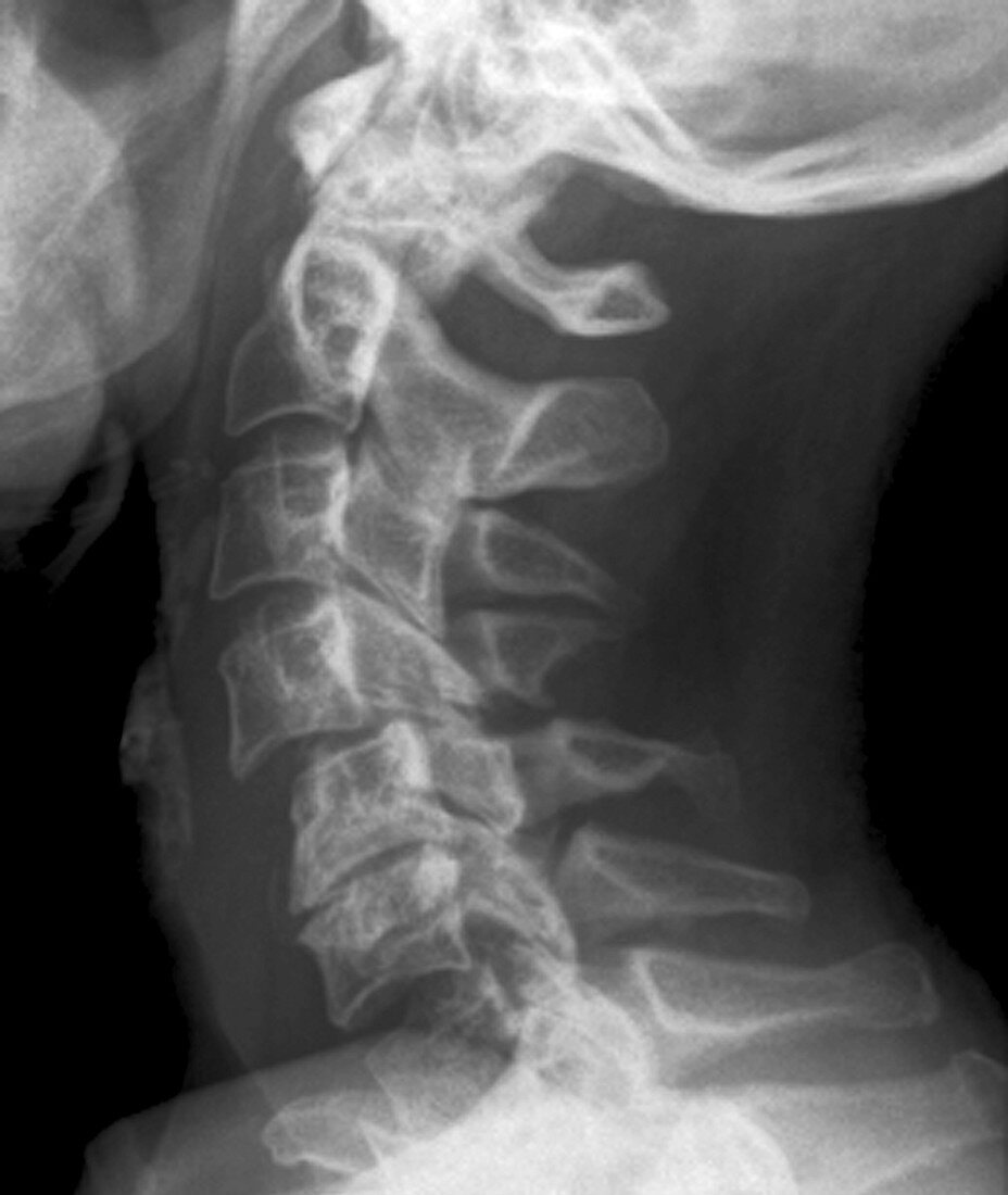 Dislocated neck bones,X-ray