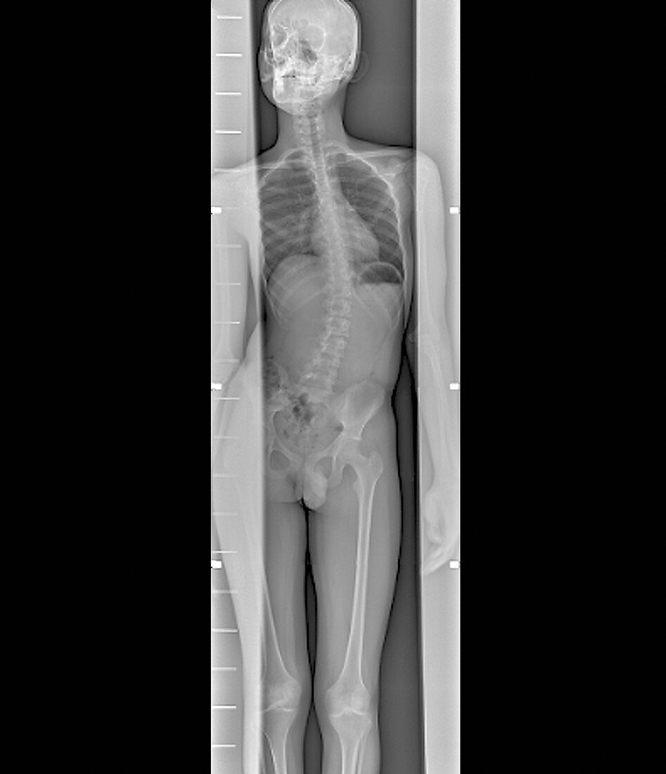 Scoliosis of the spine,whole body X-ray