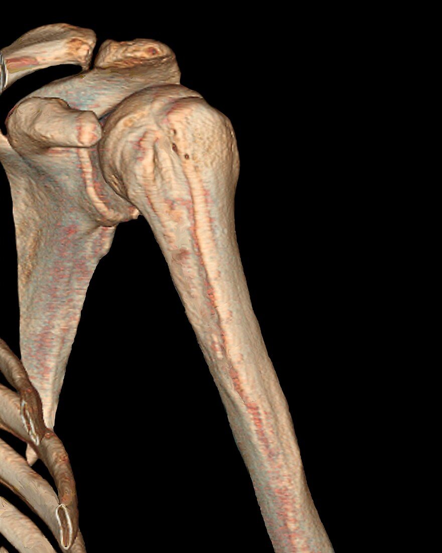 Healthy shoulder bones,3D CT scan