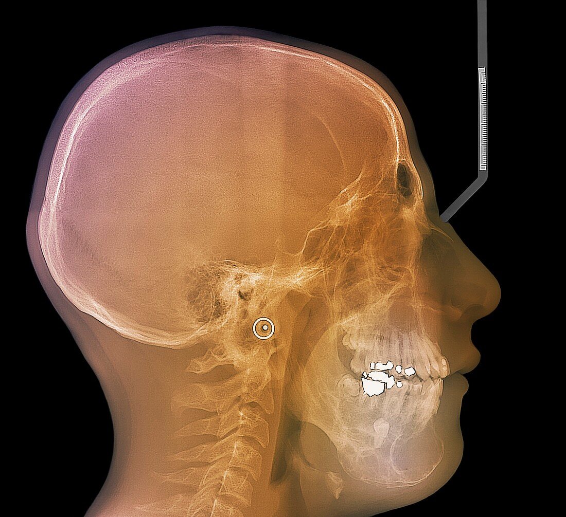 Jaw cancer (ameloblastoma),X-ray