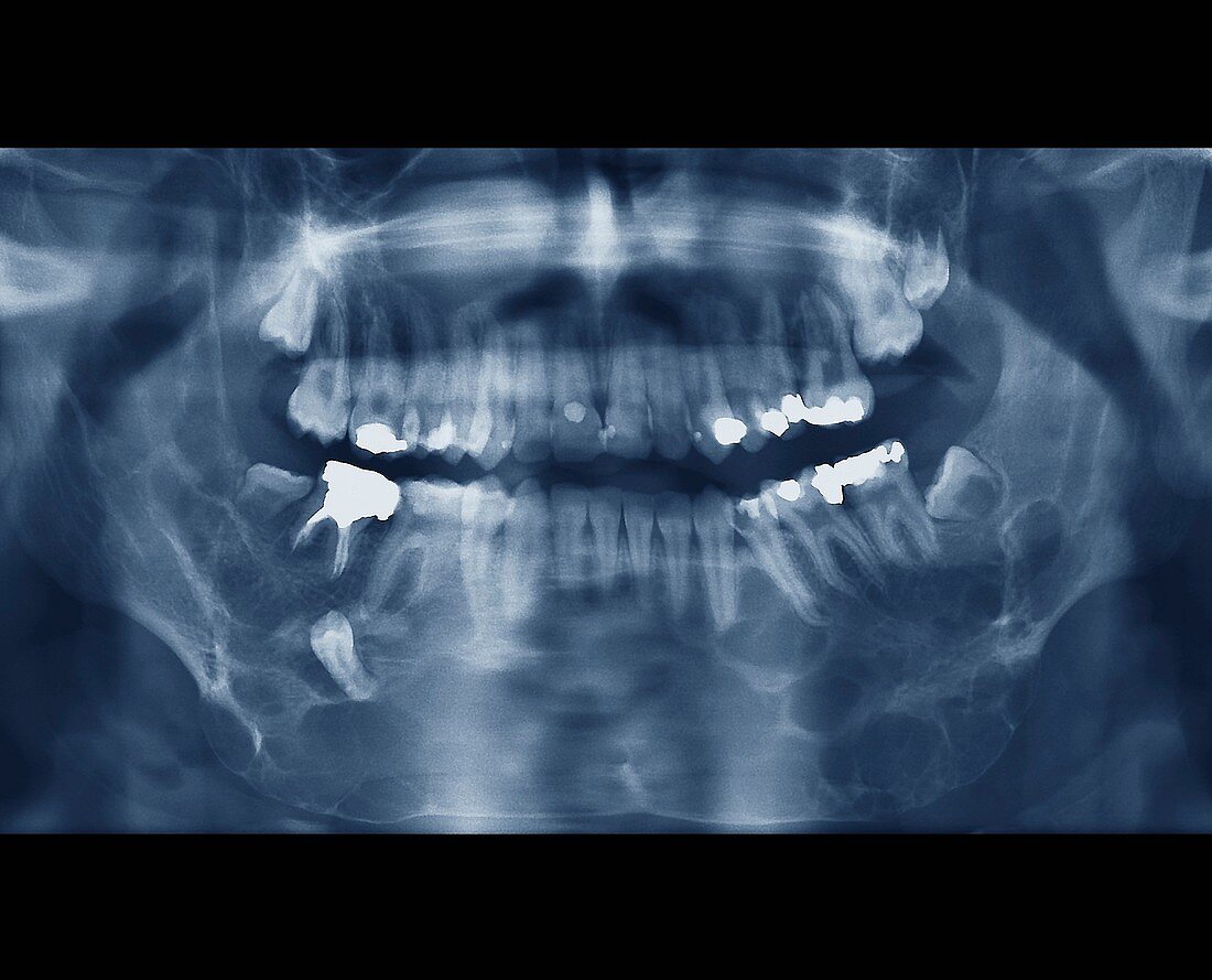 Jaw cancer (ameloblastoma),X-ray