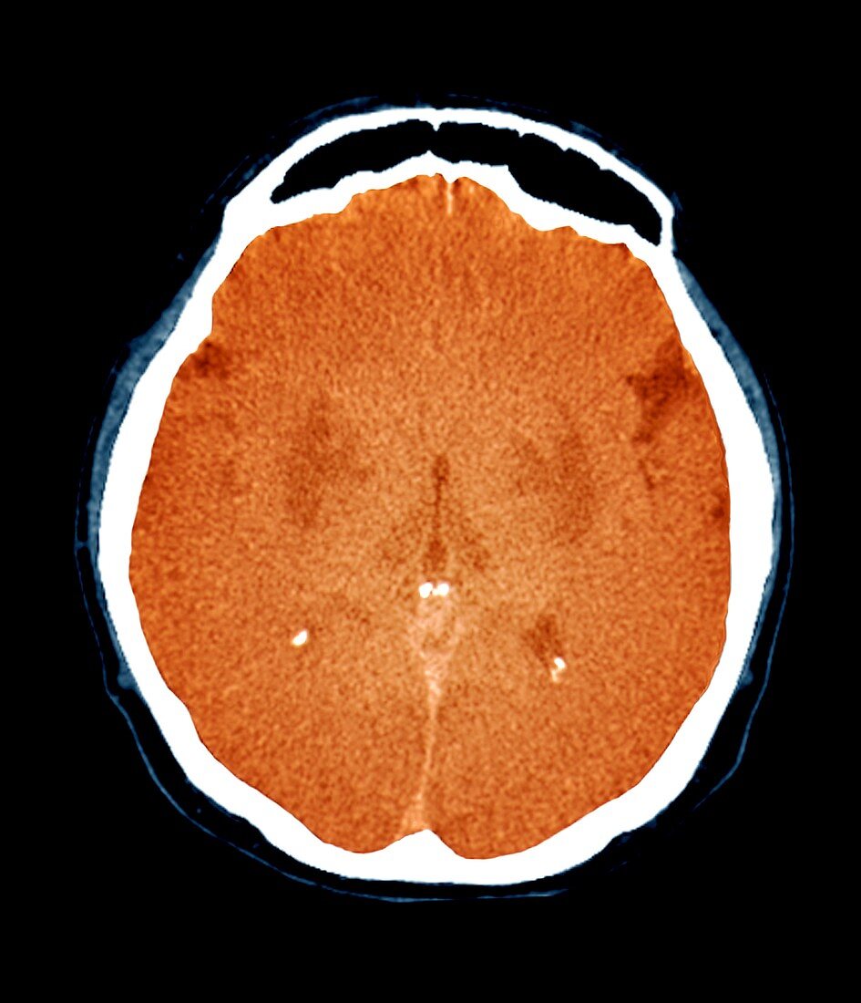 Brain in a coma,CT scan