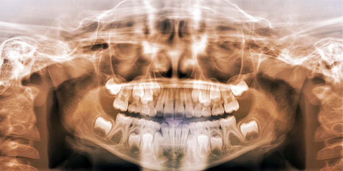 Eruption of adult teeth,X-ray