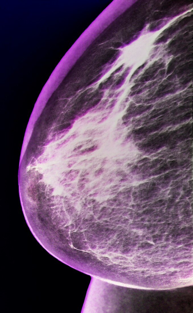 Breast cancer,X-ray mammogram