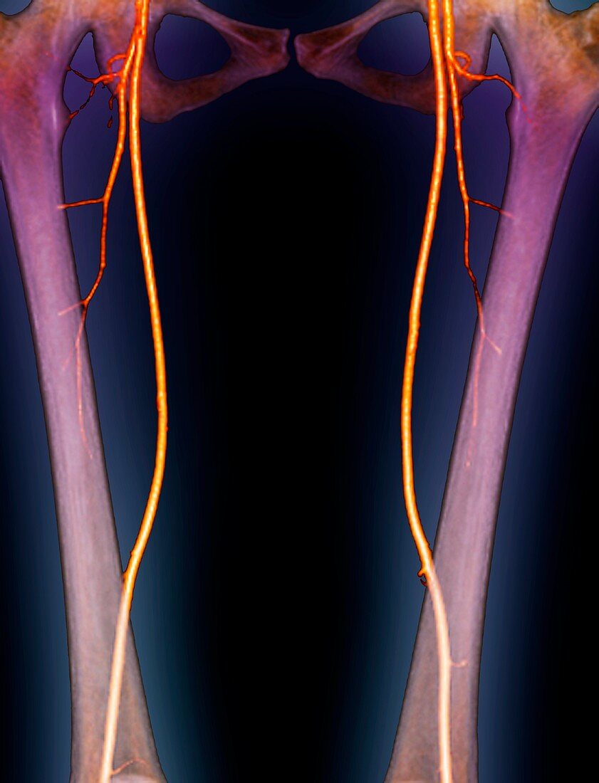 Femoral arteries,3D CT scan