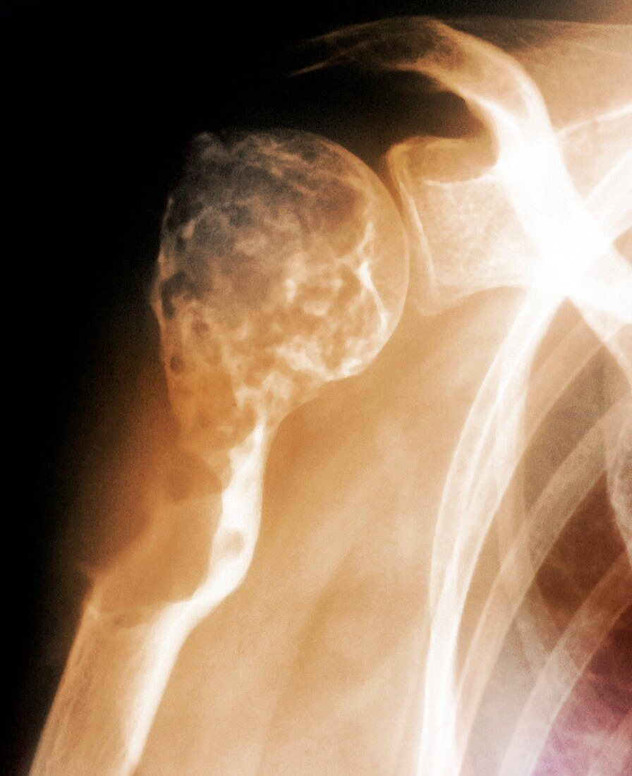 Cancer of the shoulder,X-ray