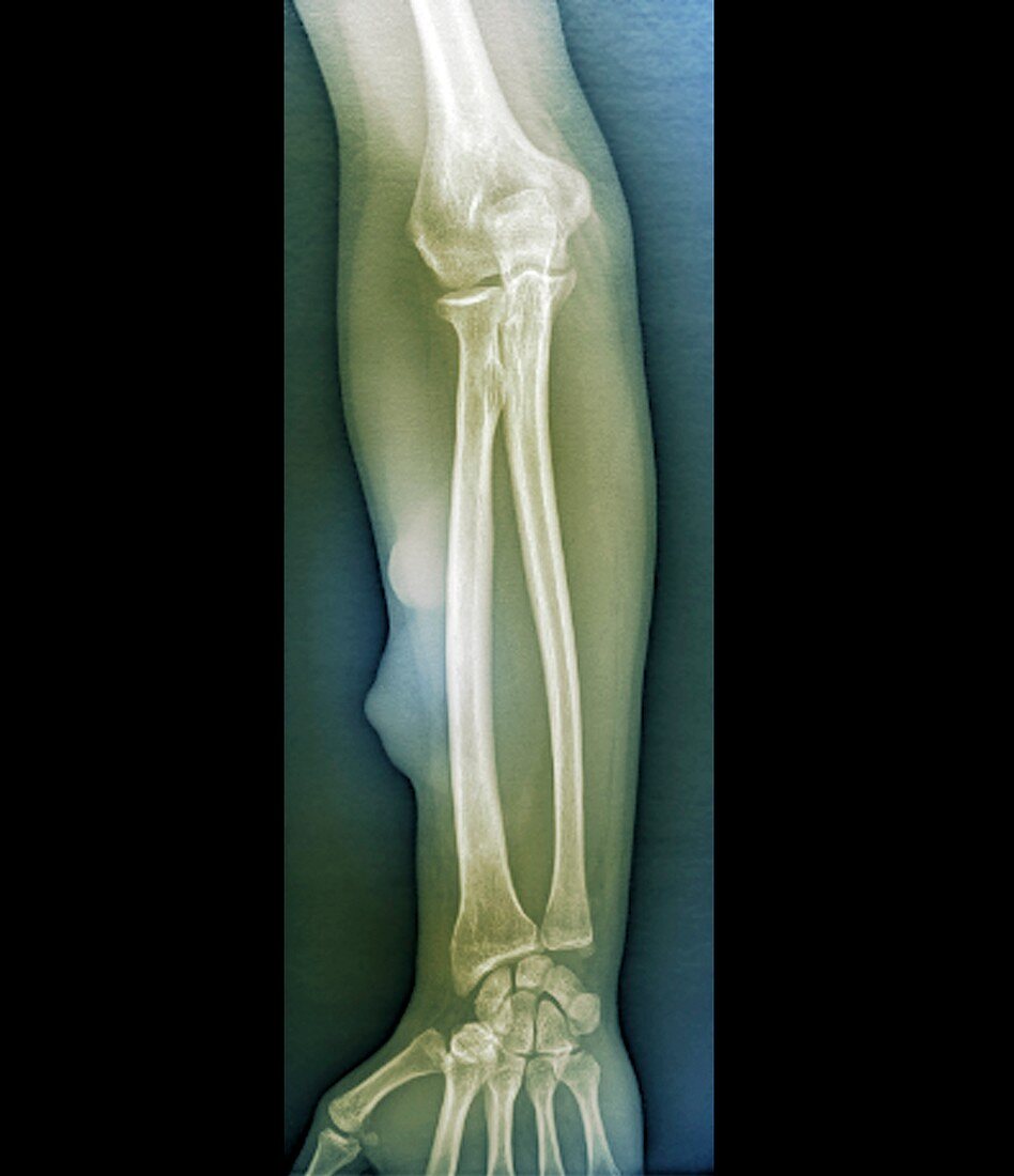 Lipoma on the arm,X-ray