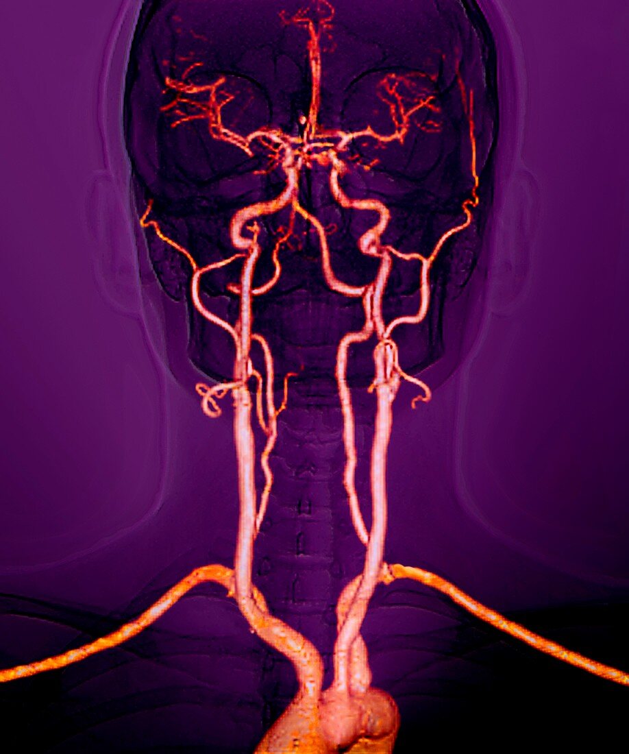 Neck arteries to the brain,CT scan