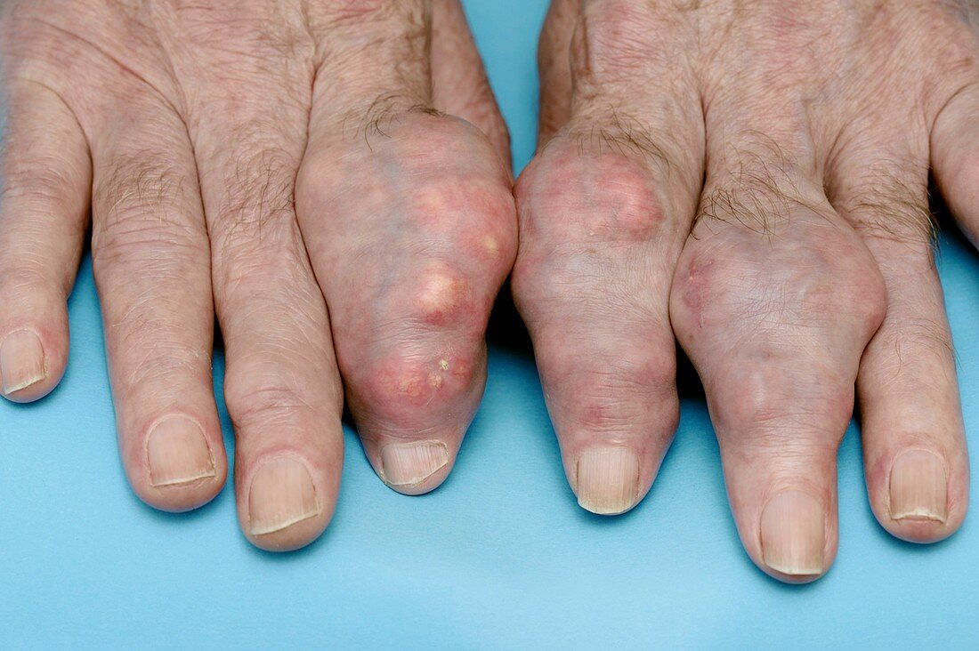 Fingers swollen with gout