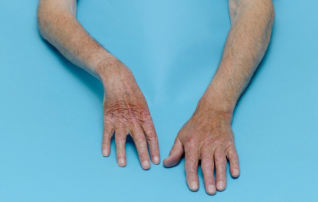 Poliomyelitis of the hand and arm