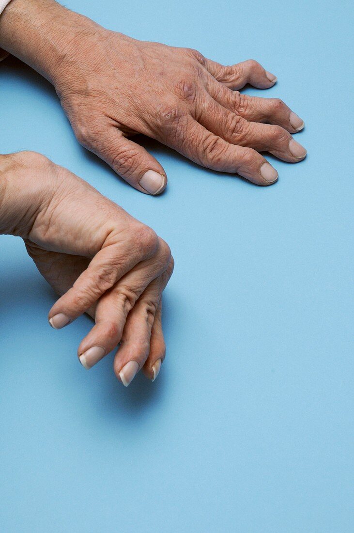 Hands with rheumatoid arthritis