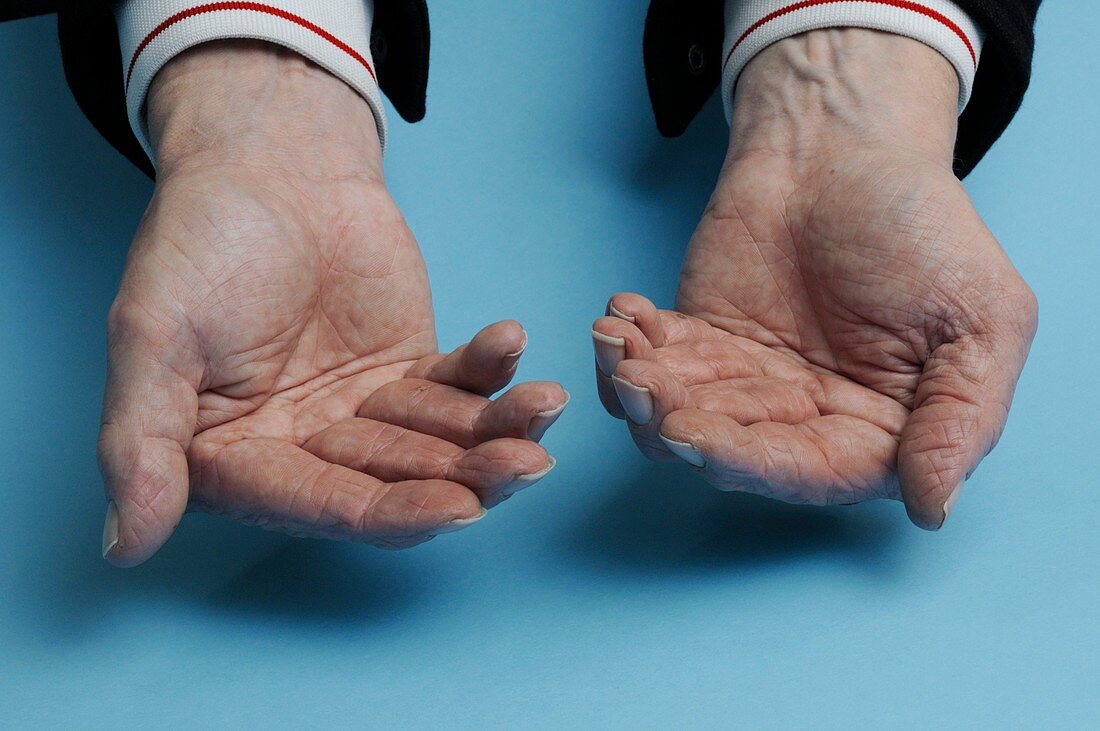 Hands with rheumatoid arthritis