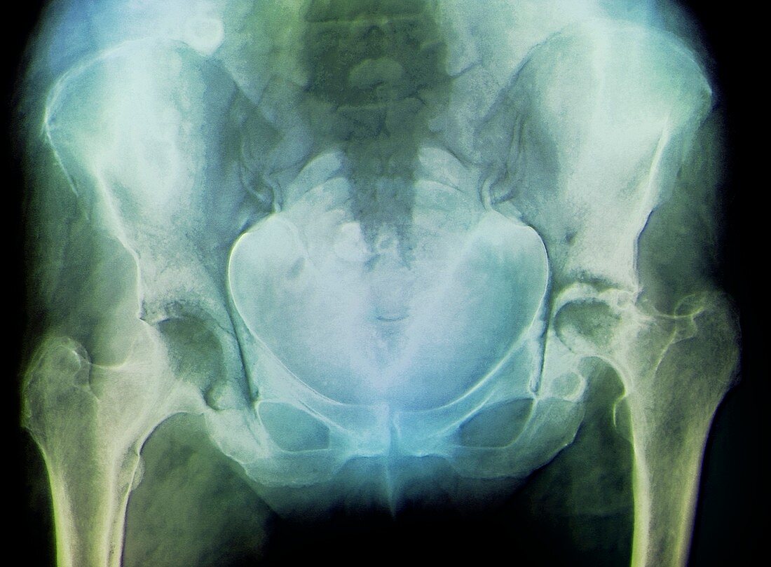 Rheumatoid arthritis of the hip,X-ray