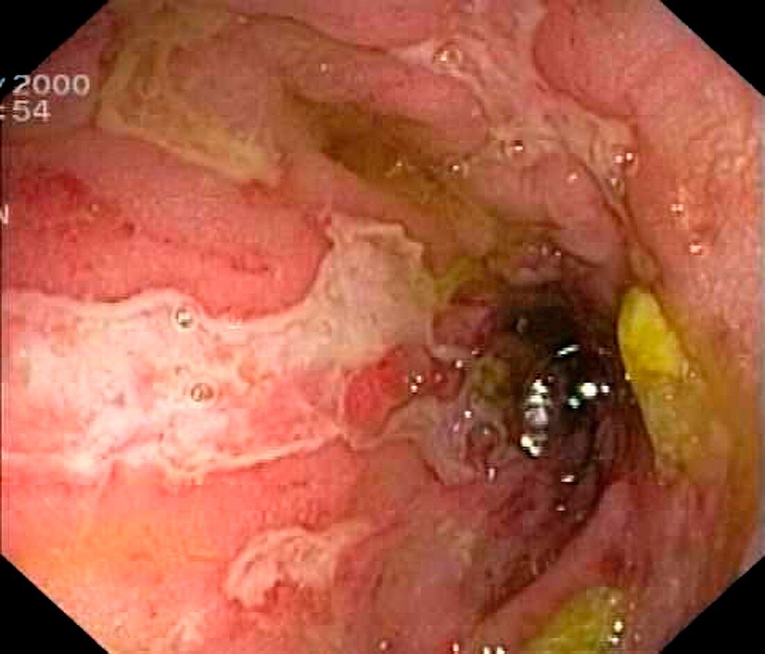 Crohn's disease in the sigmoid colon