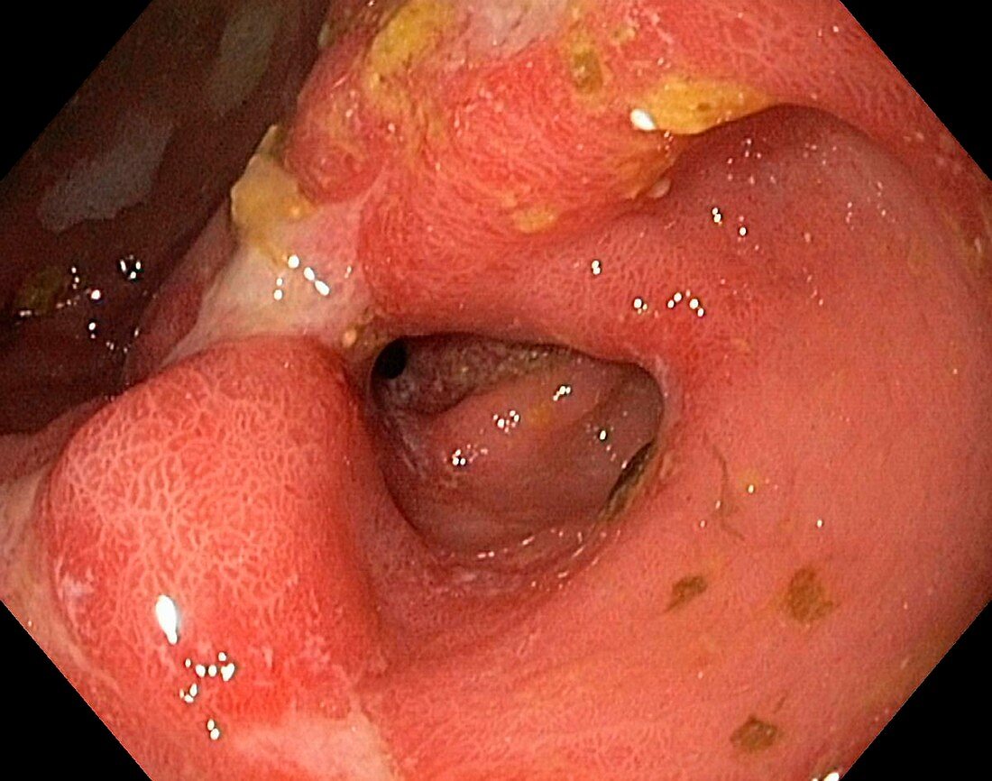 Prepyloric ulcer in the stomach