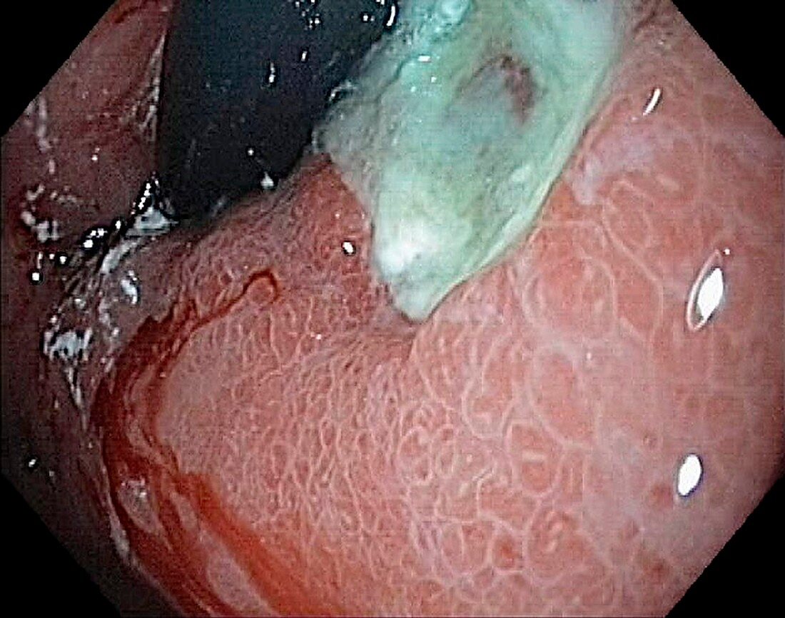 Ulcerated cancer in the stomach