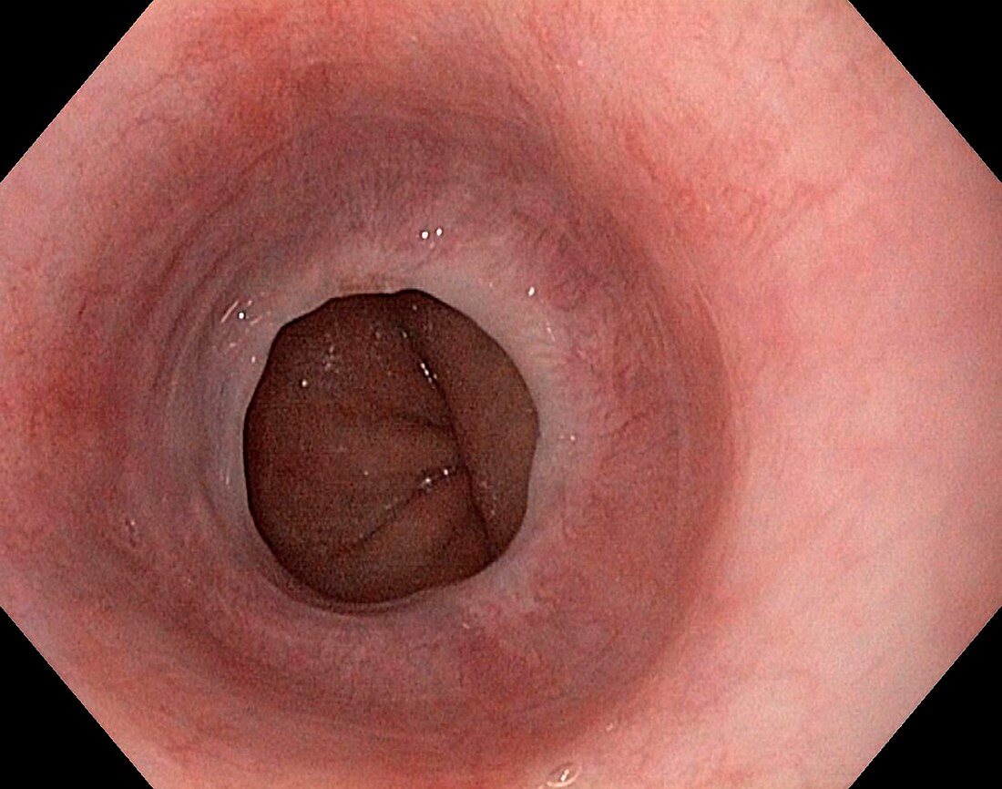 Oesophageal web from reflux