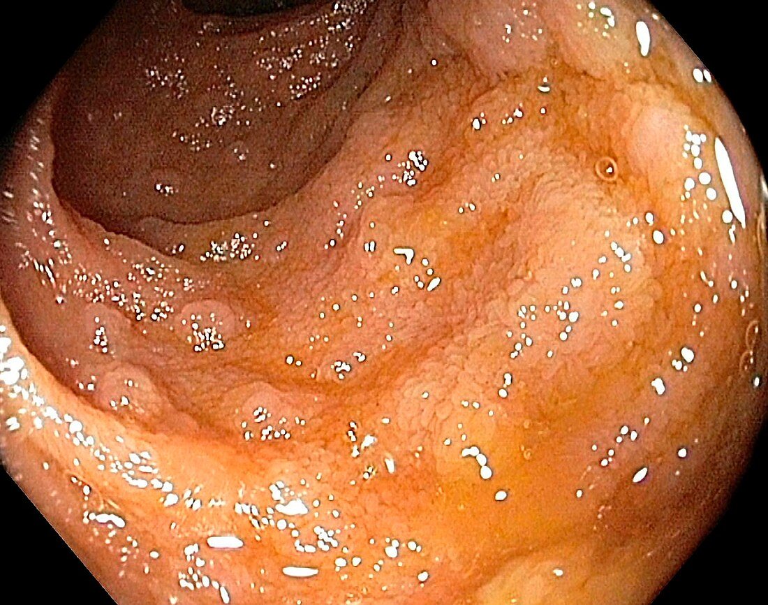 Lymphoid hyperplasia in small intestine