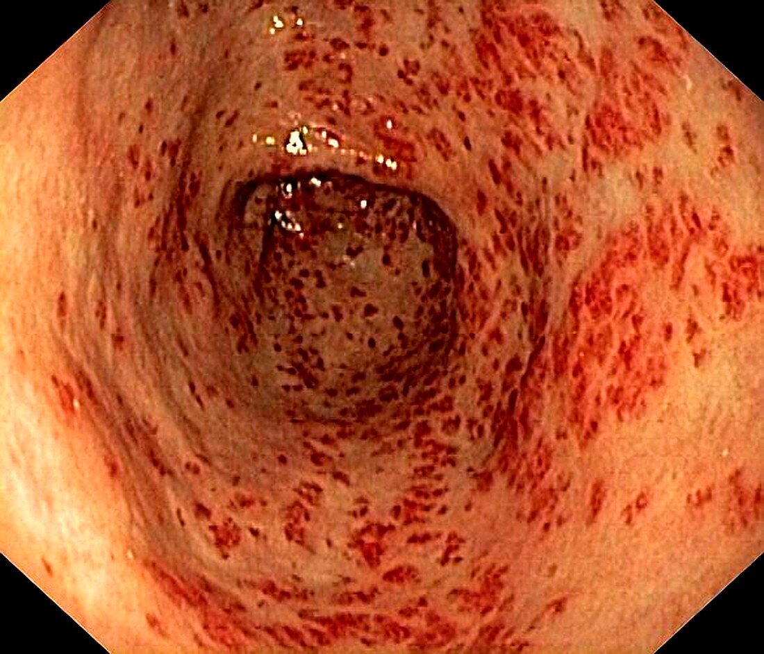 Vascular ectasia in the stomach